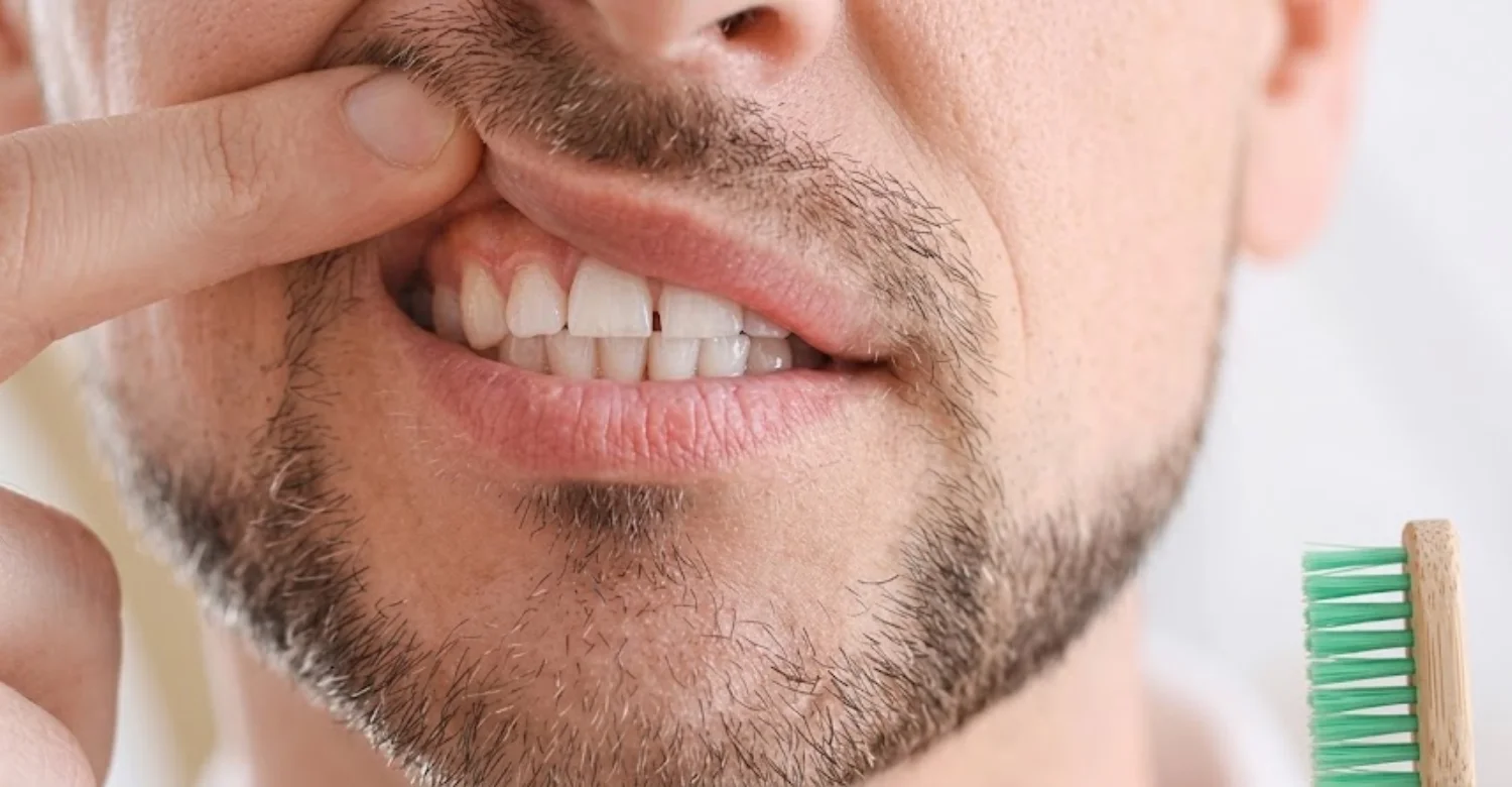 Itchy Gums1